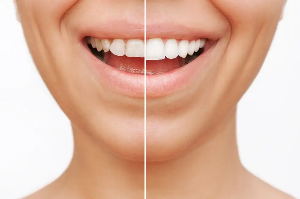 dentiste-collignon-audrey-facettes-ceramiques-2